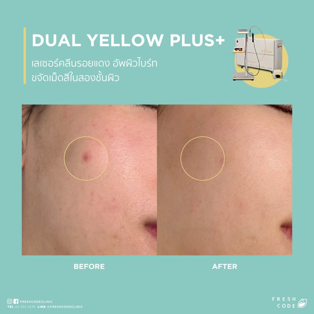 Dual Yellow Plus before and after: Reduces acne redness, laser treatment for acne and redness, resulting in smoother skin at Fresh Code Clinic.