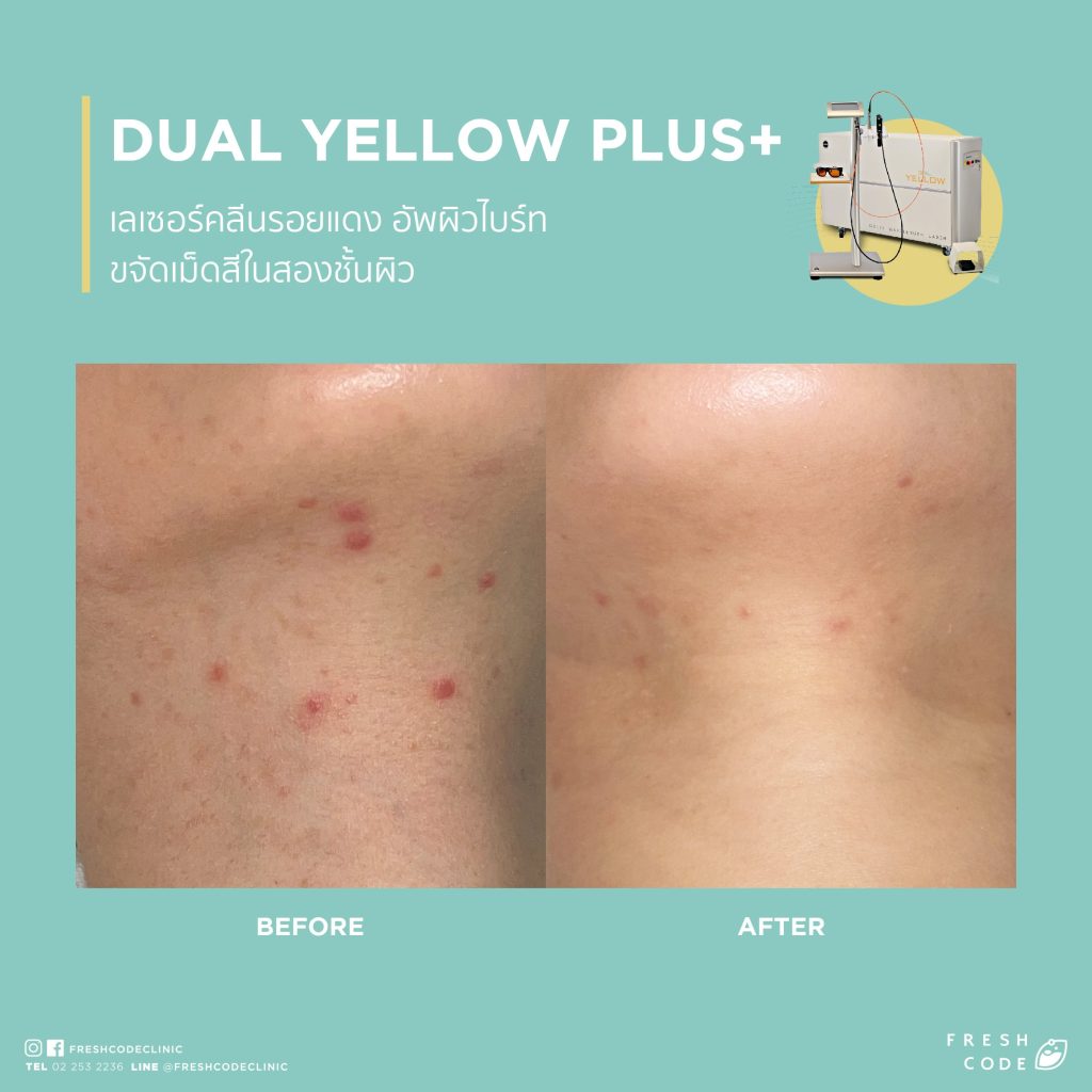 Dual Yellow Plus before and after: Reduces acne redness, laser treatment for acne and redness, resulting in smoother skin at Fresh Code Clinic.