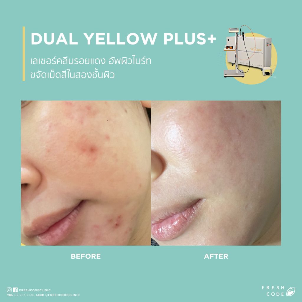 Dual Yellow Plus before and after: Reduces acne redness, laser treatment for acne and redness, resulting in smoother skin at Fresh Code Clinic.