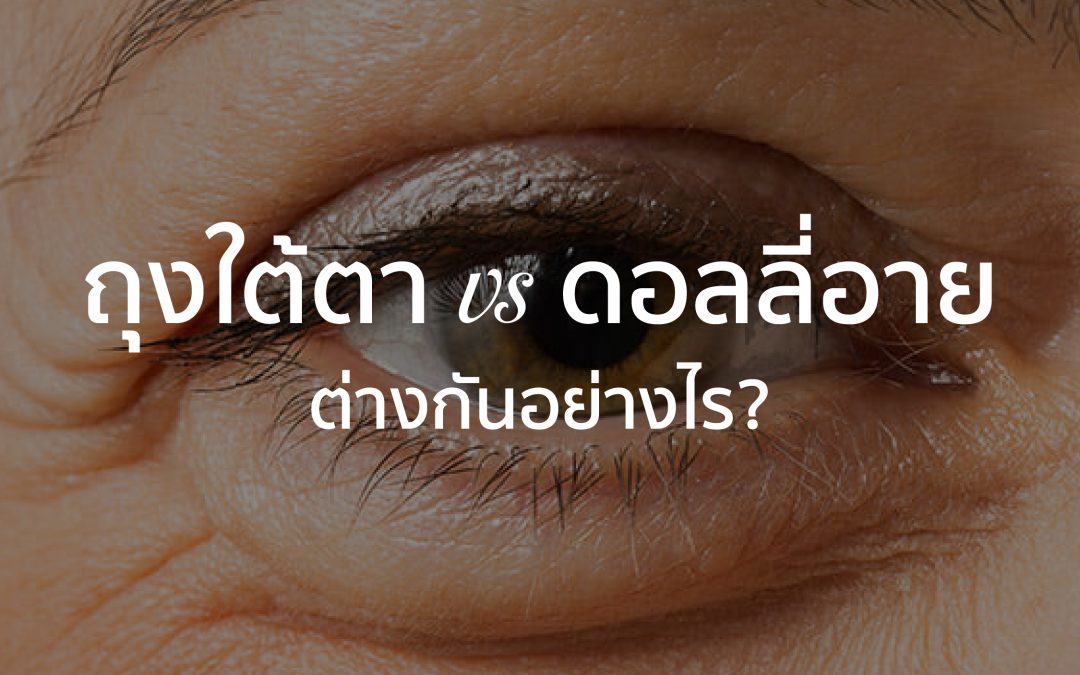 ถุงใต้ตา vs Dolly Eye – ต่างกันอย่างไร? เข้าใจให้ชัดก่อนเลือกทำหรือรักษา**