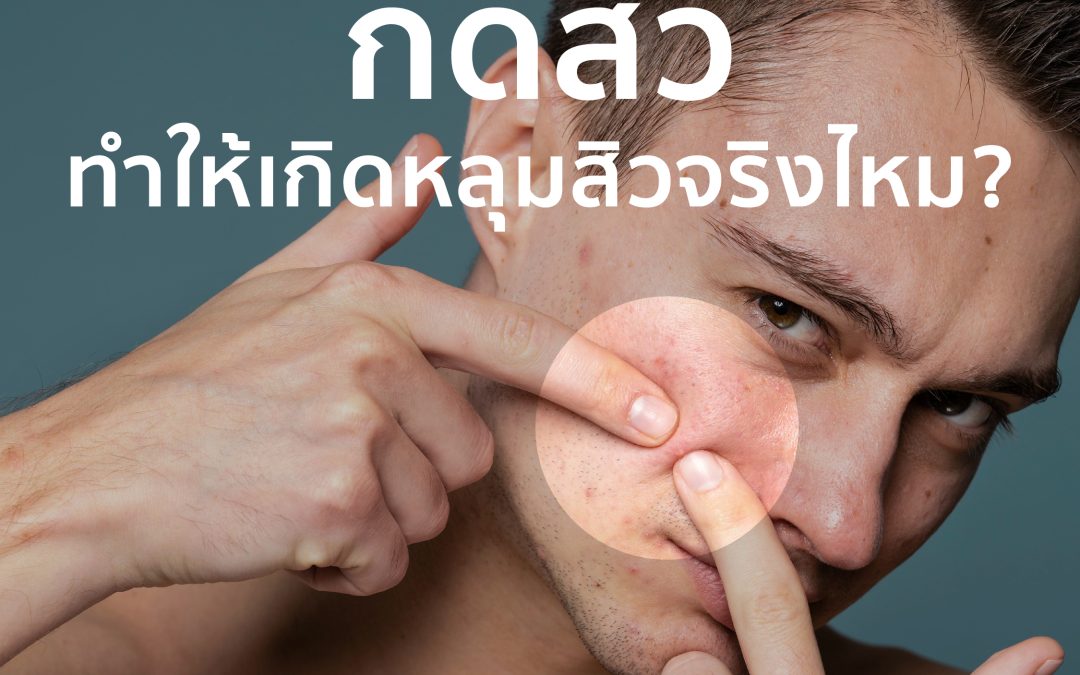 การกดสิวทำให้เกิดหลุมสิวจริงไหม?