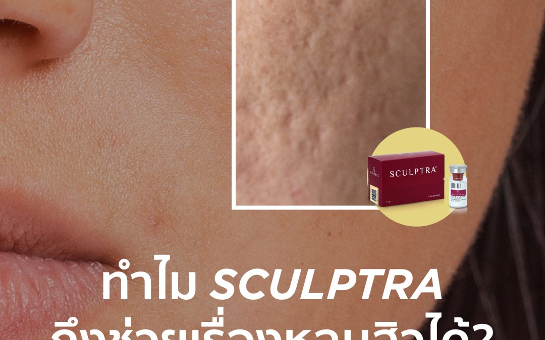 ทำไม Sculptra ถึงช่วยเรื่องหลุมสิวได้?