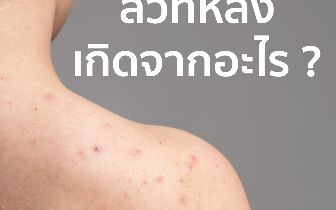 สิวที่หลังเกิดจากอะไร ? เเละมีวิธีดูเเลรักษาอย่างไร