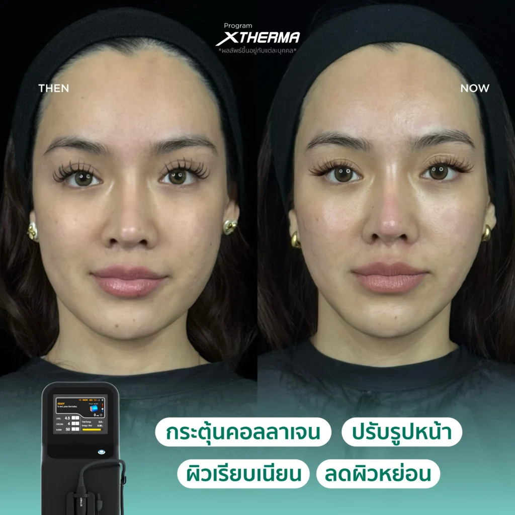 مراجعة نتائج علاج XTherma قبل وبعد العلاج في عيادة Fresh Code Clinic 4.