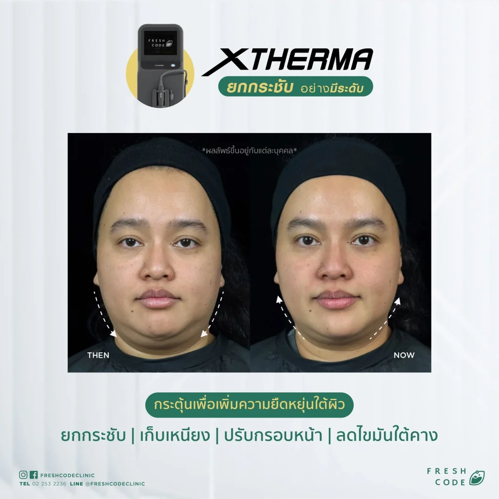 Before and After XTherma skin tightening treatment helps lift and firm the facial contours, reduce double chin, and stimulate collagen production under the skin. Performed by doctors at Fresh Code Clinic, Bangkok.