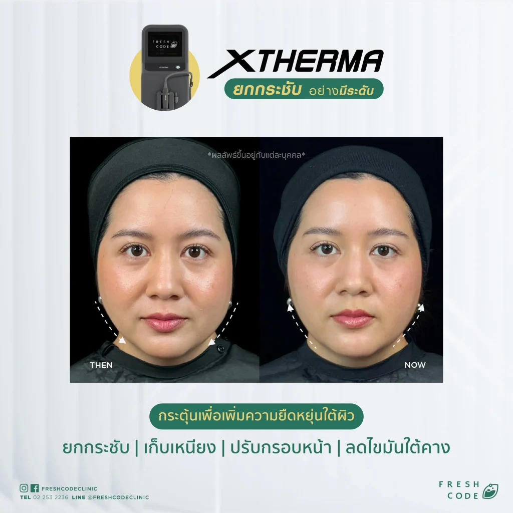 Before and After XTherma skin tightening treatment helps lift and firm the facial contours, reduce double chin, and stimulate collagen production under the skin. Performed by doctors at Fresh Code Clinic, Bangkok.