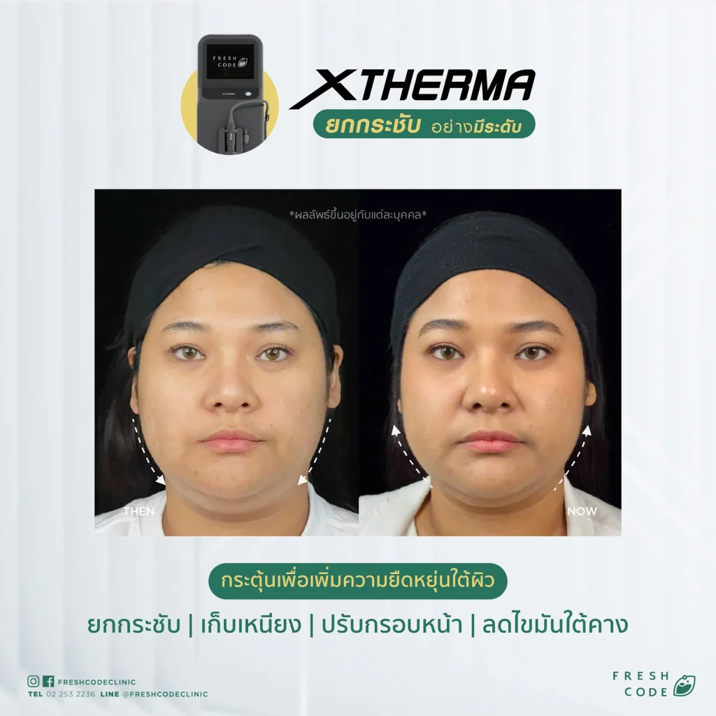 Before and After XTherma skin tightening treatment helps lift and firm the facial contours, reduce double chin, and stimulate collagen production under the skin. Performed by doctors at Fresh Code Clinic, Bangkok.