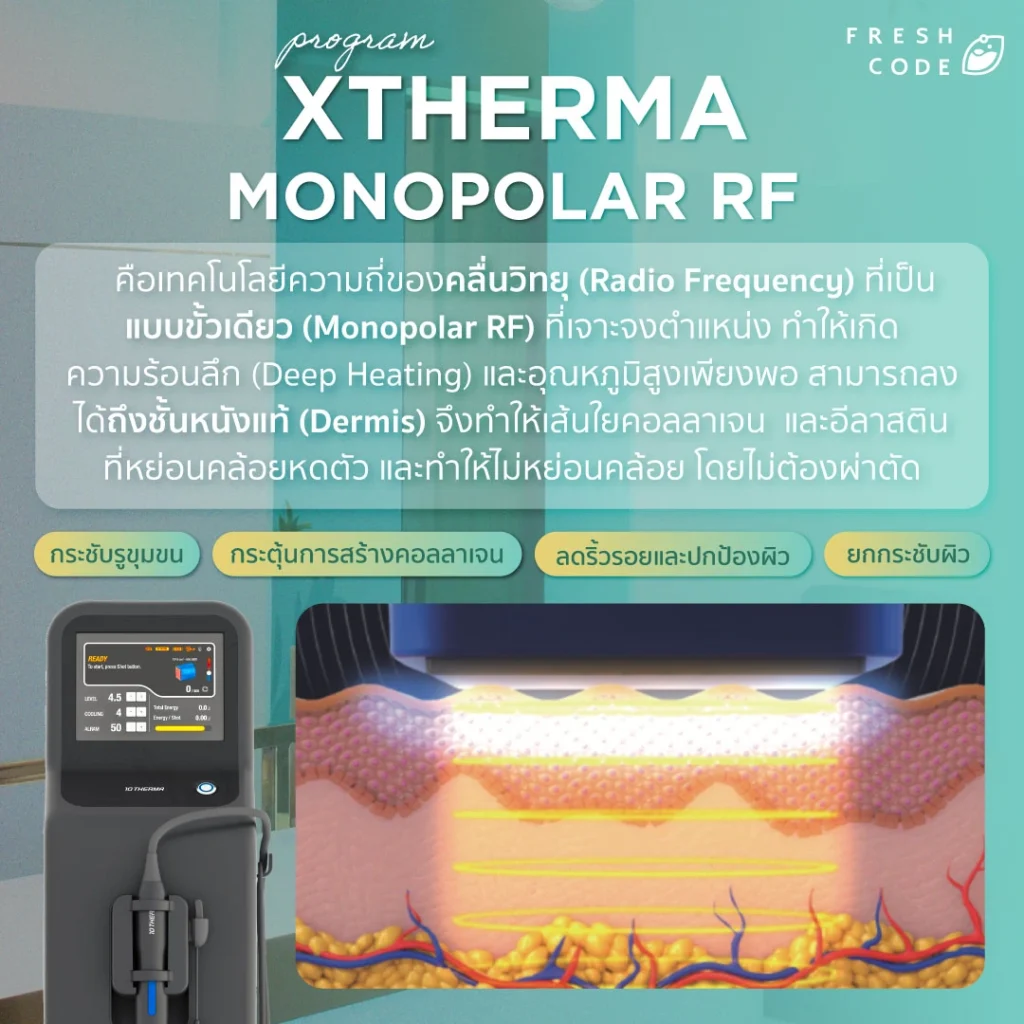 مبدأ تشغيل جهاز XTherma باستخدام طاقة الترددات الراديوية أحادية القطب.