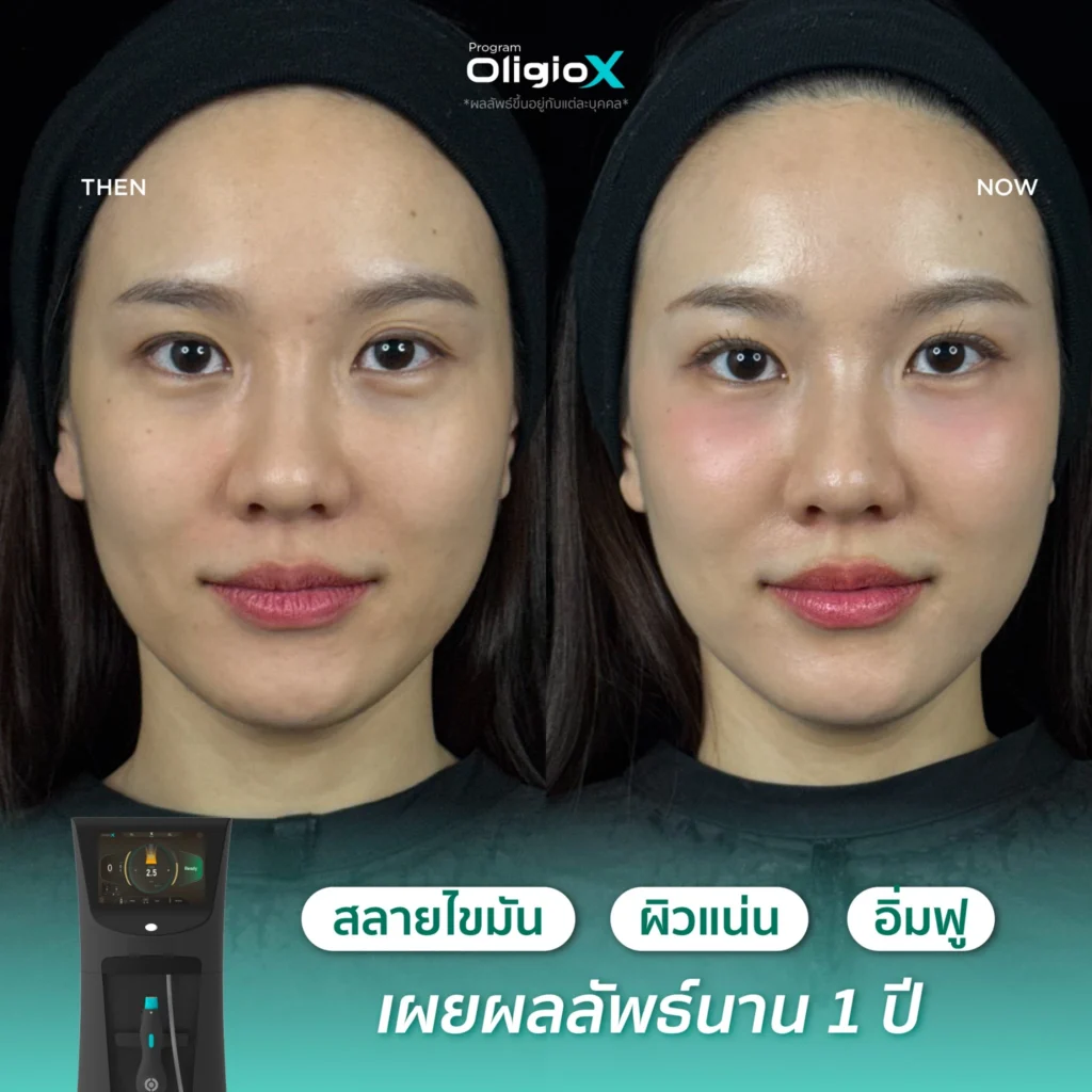 รีวิวผลลัพธ์ Oligio X บริเวณกรอบหน้าก่อนและหลังทำที่ Fresh Code Clinic