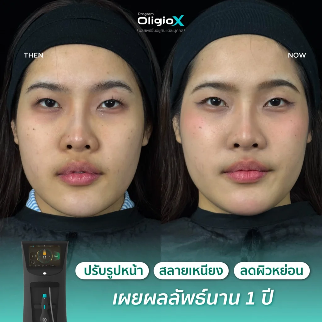 รีวิวผลลัพธ์ Oligio X บริเวณกรอบหน้าก่อนและหลังทำที่ Fresh Code Clinic