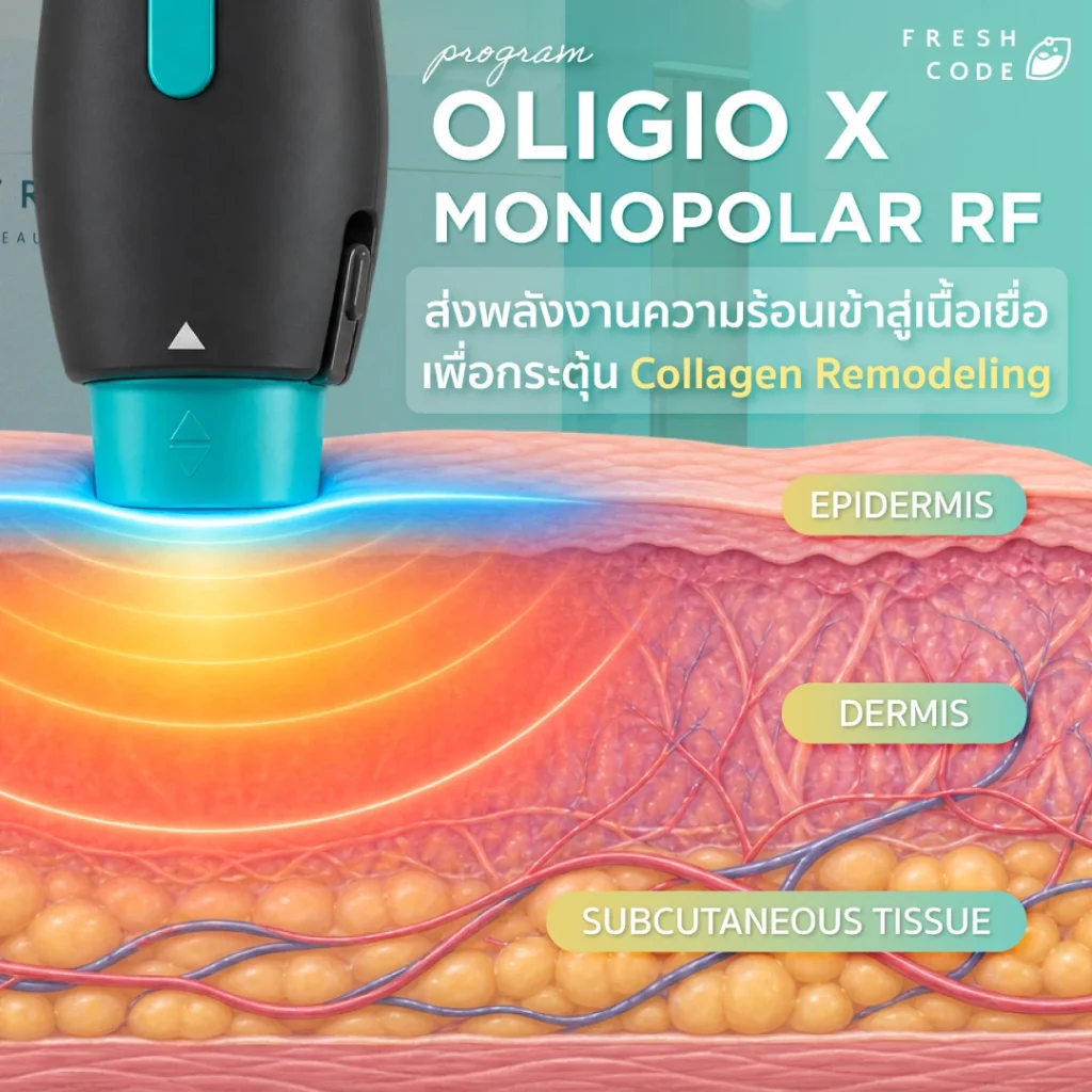 หลักการทำงานของ Oligio X ด้วยพลังงาน Monopolar RF ใต้ชั้นผิว