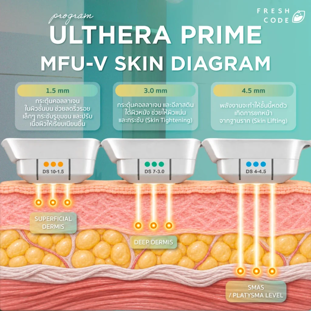 Ulthera Prime 可将能量输送到 SMAS 层 1.5 毫米、3.0 毫米和 4.5 毫米的深度。