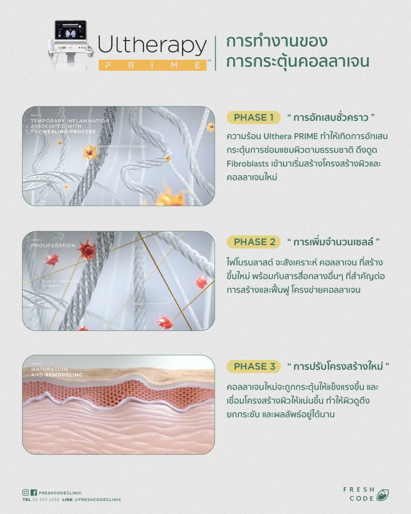Ultherapy Prime ultrasound skin lifting technology ยิงพลังงาน 3 ระดับลงลึกถึงชั้นคอลลาเจนและ SMAS เพื่อยกกระชับผิว
