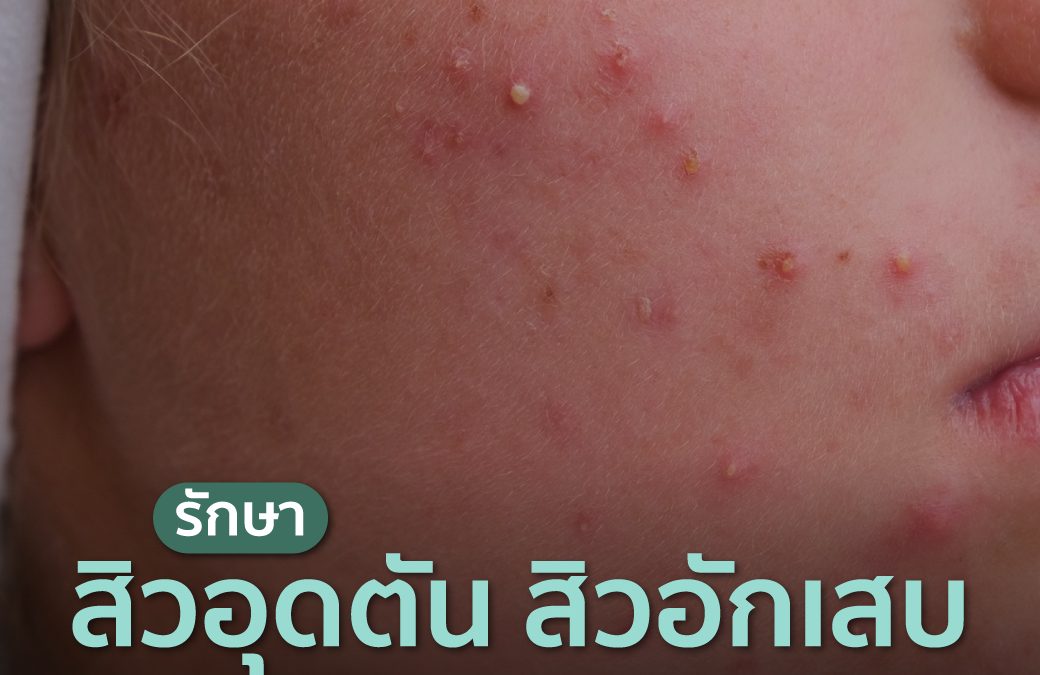 รักษาสิวอุดตัน สิวอักเสบ แบบไม่กินยา ทำได้ไหม?