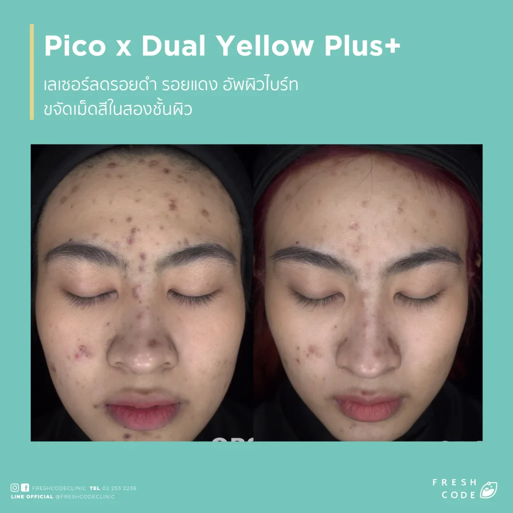 Pico Discovery before and after: Reduces dark spots, acne scars, and evens out skin tone.
