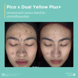 Pico Discovery before and after: Reduces dark spots, acne scars, and evens out skin tone.