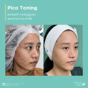 Pico Discovery before and after: Reduces dark spots, acne scars, and evens out skin tone.