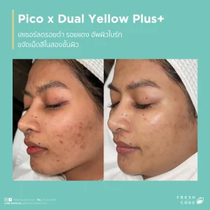 Pico Discovery before and after: Reduces dark spots, acne scars, and evens out skin tone.