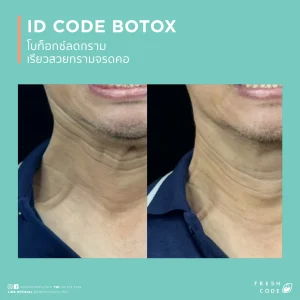 Before and after Botox results for wrinkle reduction and facial contouring. Before and after Botox for reducing forehead wrinkles, frown lines, and crow's feet. Before and after Botox images for a smoother-looking face. Botox before and after for wrinkle reduction and a sharper facial contour. Before and after Botox results for those concerned about wrinkles and facial shape. Botox before and after for smoother-looking skin and a more defined jawline. Before and after Botox for forehead lines, frown lines, and crow's feet. Botox before and after results for facial lines and a softer appearance. Before and after Botox for wrinkle reduction and facial contour refinement. Botox before and after for a smoother, more refreshed look.
