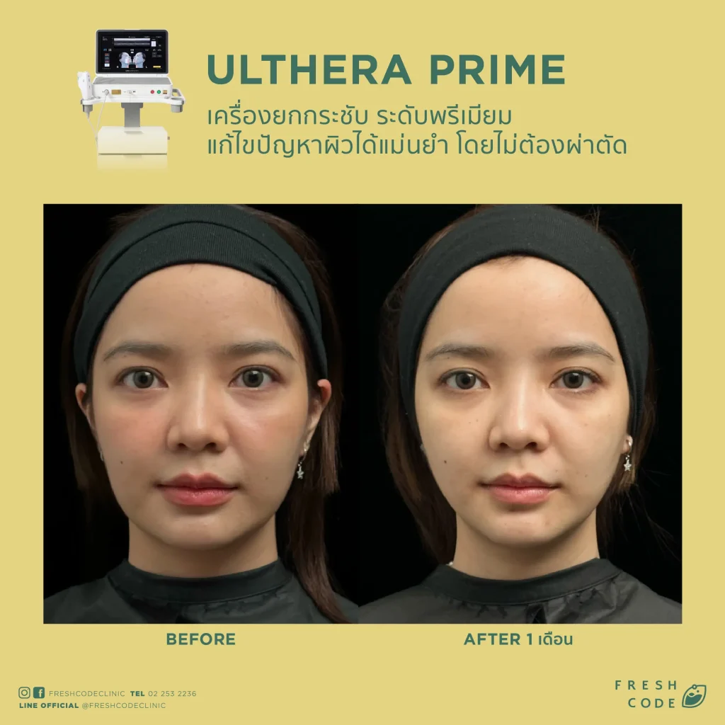 Ultherapy Prime before and after review: Results of face and eyebrow lifting using Microfocused Ultrasound technology at Fresh Code Clinic.