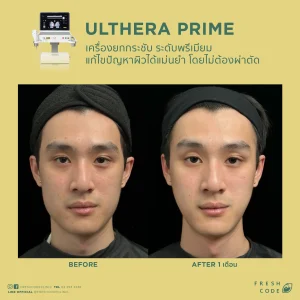 Ultherapy Prime before and after review: Results of face and eyebrow lifting using Microfocused Ultrasound technology at Fresh Code Clinic.