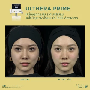 Ultherapy Prime before and after review: Results of face and eyebrow lifting using Microfocused Ultrasound technology at Fresh Code Clinic.