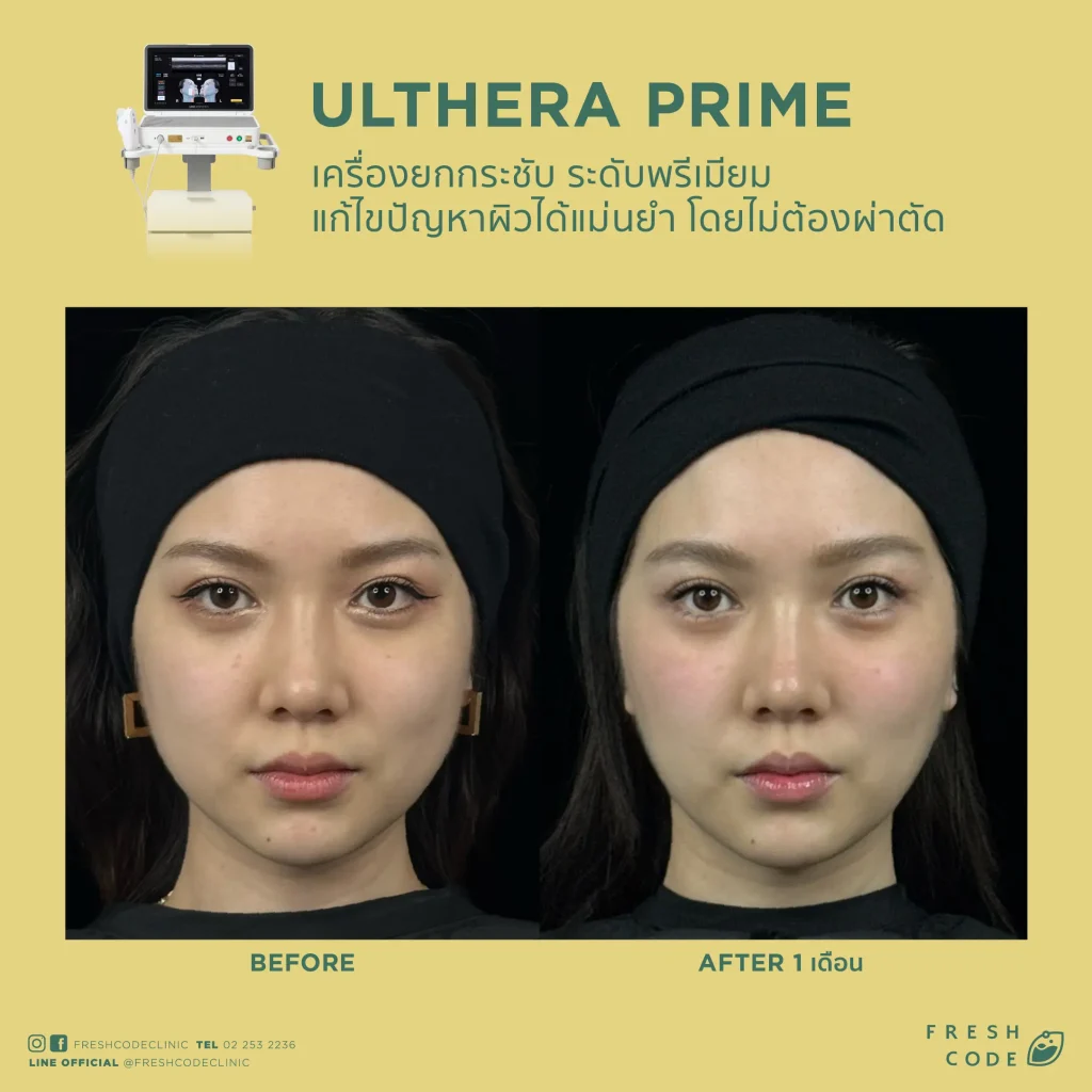 Ultherapy Prime before and after review: Results of face and eyebrow lifting using Microfocused Ultrasound technology at Fresh Code Clinic.