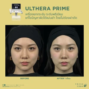 Ultherapy Prime before and after review: Results of face and eyebrow lifting using Microfocused Ultrasound technology at Fresh Code Clinic.