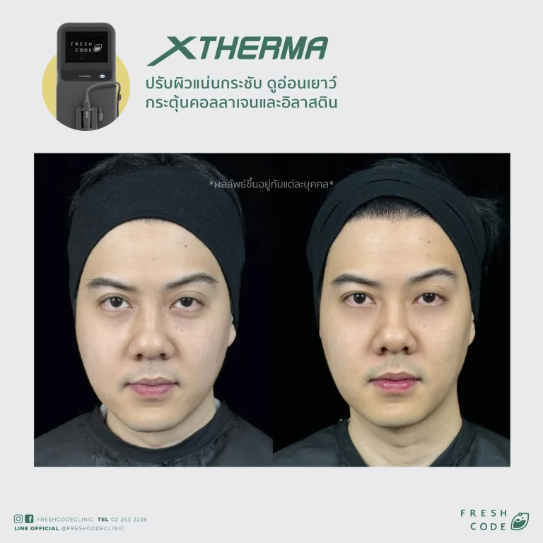 Before After XTherma skin tightening treatment ช่วยยกกระชับกรอบหน้า ลดเหนียง และกระตุ้นคอลลาเจนใต้ผิว โดยแพทย์ที่ Fresh Code Clinic กรุงเทพ