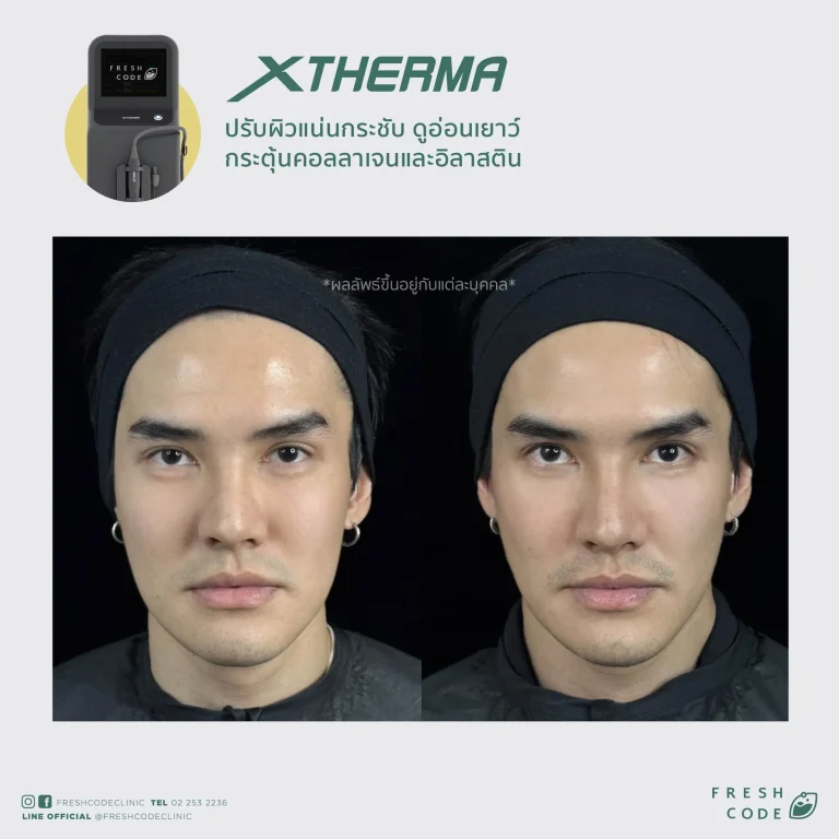 Before After XTherma skin tightening treatment ช่วยยกกระชับกรอบหน้า ลดเหนียง และกระตุ้นคอลลาเจนใต้ผิว โดยแพทย์ที่ Fresh Code Clinic กรุงเทพ