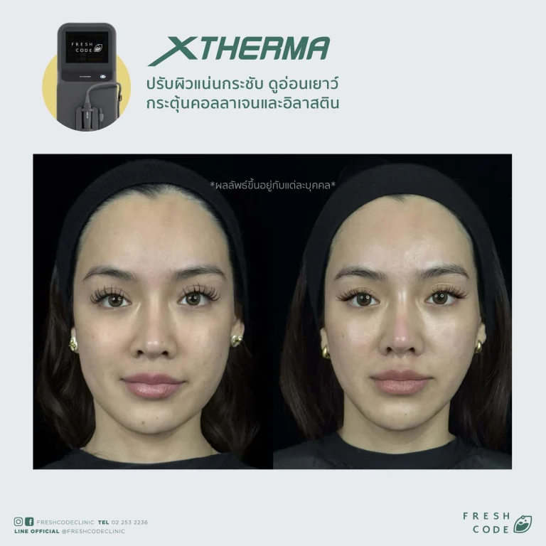 Before After XTherma skin tightening treatment ช่วยยกกระชับกรอบหน้า ลดเหนียง และกระตุ้นคอลลาเจนใต้ผิว โดยแพทย์ที่ Fresh Code Clinic กรุงเทพ