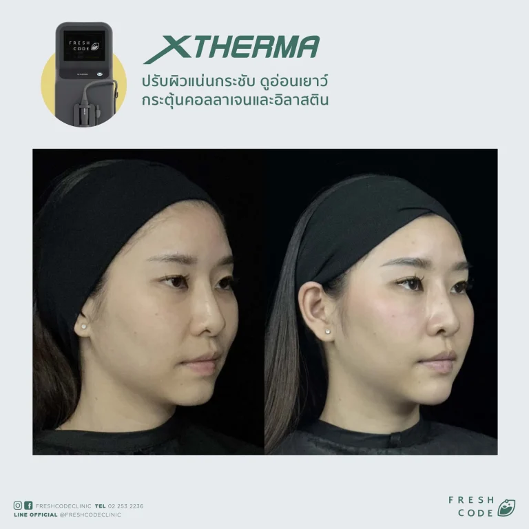 Before After XTherma skin tightening treatment ช่วยยกกระชับกรอบหน้า ลดเหนียง และกระตุ้นคอลลาเจนใต้ผิว โดยแพทย์ที่ Fresh Code Clinic กรุงเทพ