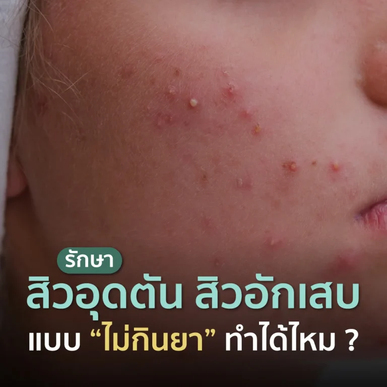 Images of clogged pores and inflamed acne on the face, along with information on non-medication acne treatments from a beauty clinic in Bangkok.