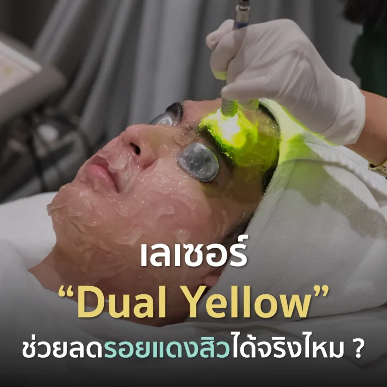 Dual Yellow laser reduces acne redness and rejuvenates the skin. Acne treatment laser at Fresh Code Clinic.