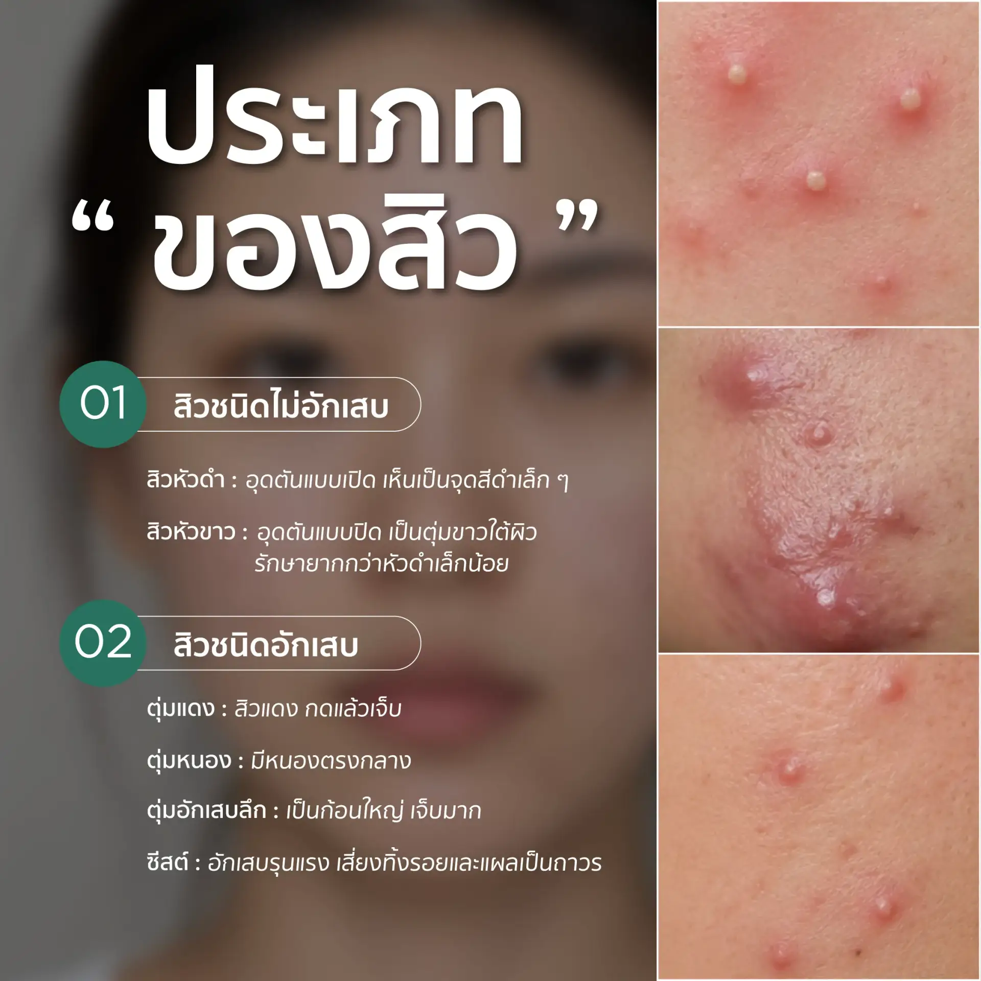 สิวมีกี่ประเภท สิวอุดตันและสิวอักเสบ