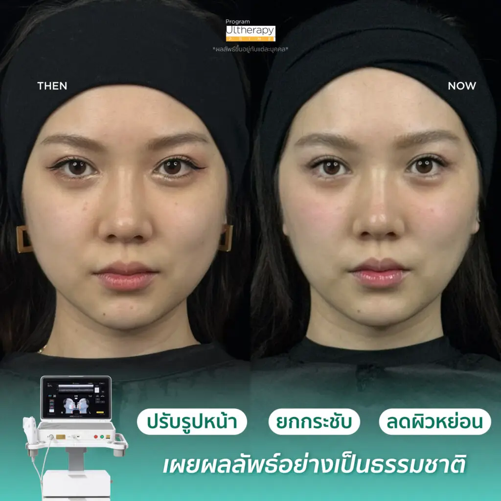 รีวิวผลลัพธ์หลังทำ Ulthera Prime ภาพที่ 1