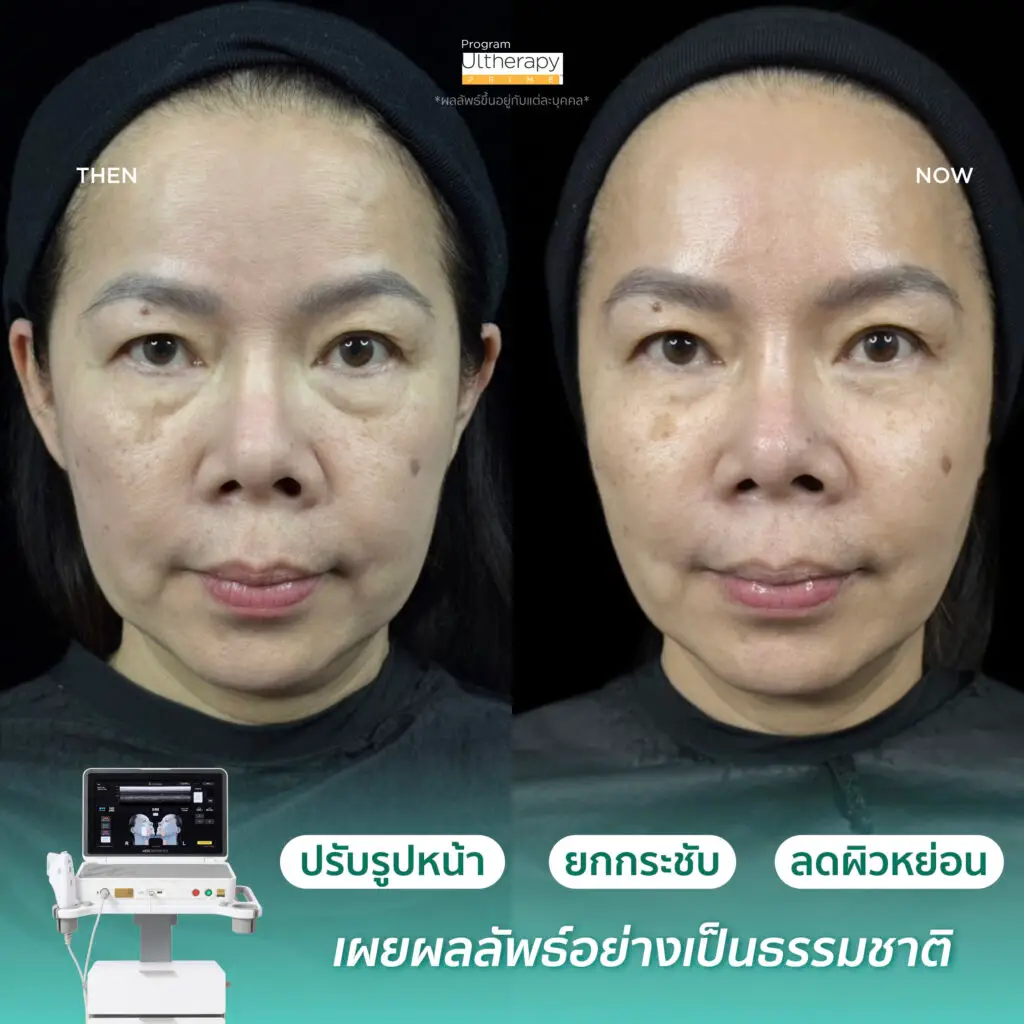 รีวิวผลลัพธ์หลังทำ Ulthera Prime ภาพที่ 2