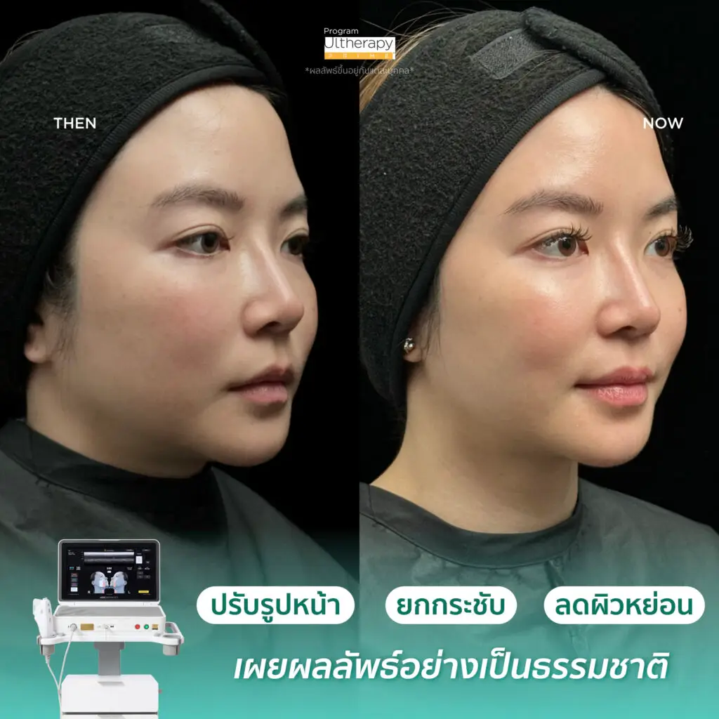 รีวิวผลลัพธ์หลังทำ Ulthera Prime ภาพที่ 4