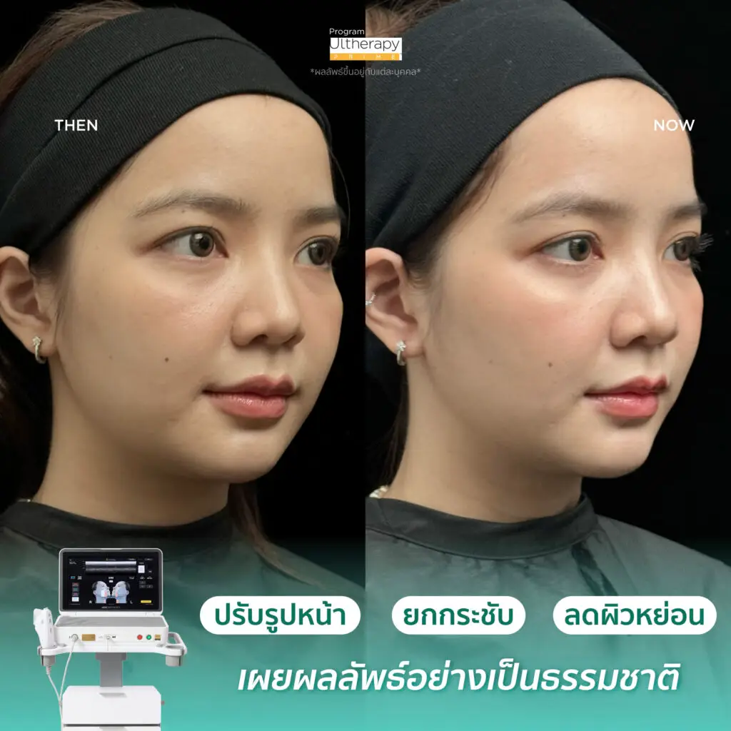 รีวิวผลลัพธ์หลังทำ Ulthera Prime ภาพที่ 3
