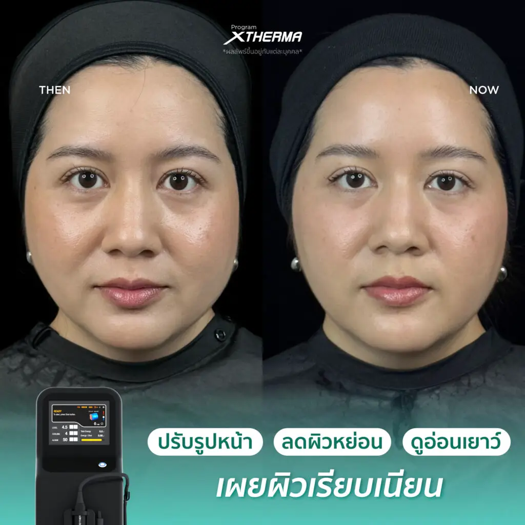 รีวิวผลลัพธ์หลังทำ XTherma ภาพที่ 2
