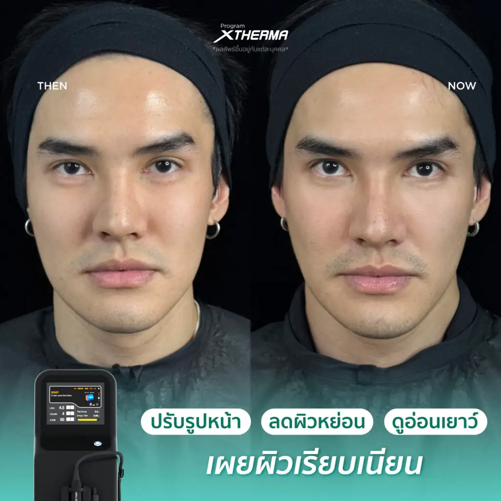 รีวิวผลลัพธ์หลังทำ XTherma ภาพที่ 3