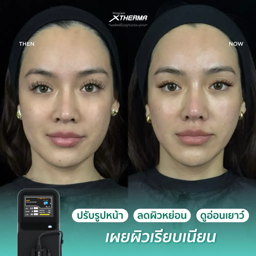 รีวิวผลลัพธ์หลังทำ XTherma ภาพที่ 4