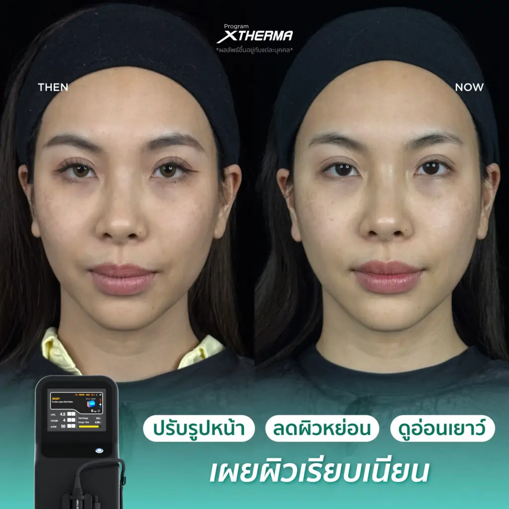 รีวิวผลลัพธ์หลังทำ XTherma ภาพที่ 1