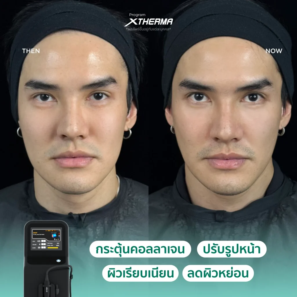 ภาพรีวิว Xtherma