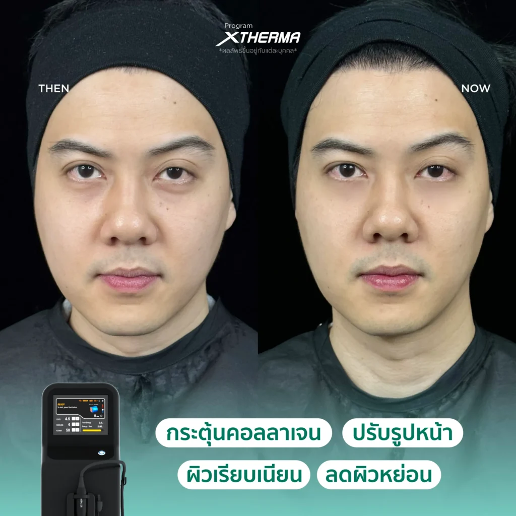 ภาพรีวิว Xtherma