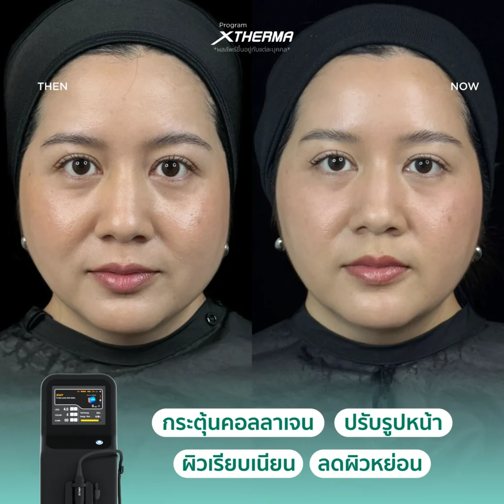 ภาพรีวิว Xtherma
