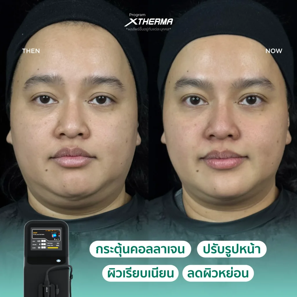 ภาพรีวิว Xtherma