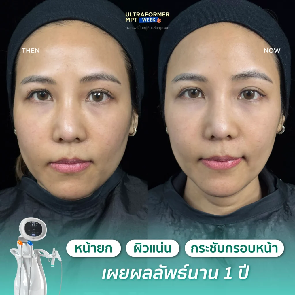 รีวิว MPT