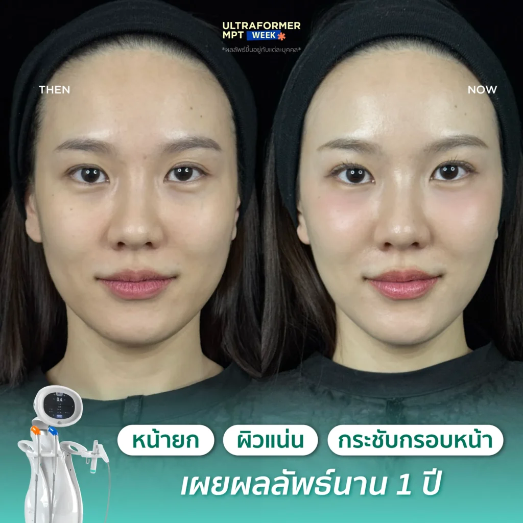 รีวิว MPT