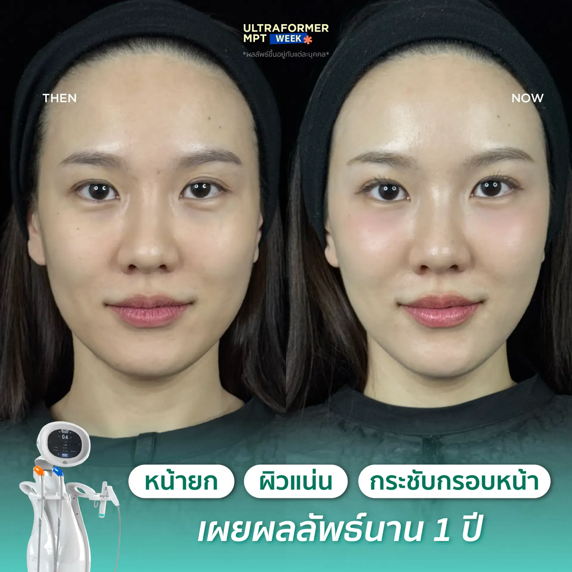 Ultraformer MPT治疗效果回顾，图2。